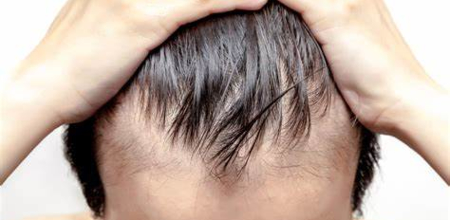 Stati Uniti, la FDA approva la prima pillola orale per l'alopecia